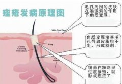 痤瘡治療的誤區(qū)有什么？痤瘡的治療要警惕哪些