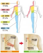 帶狀皰疹癥狀表現(xiàn)是什么樣的？